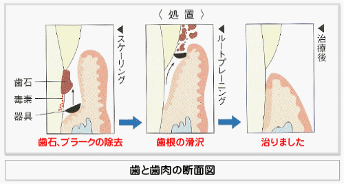 歯と歯肉の断面図