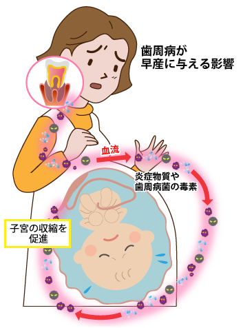 妊婦さんの歯周病がお子さんにもたらすリスク